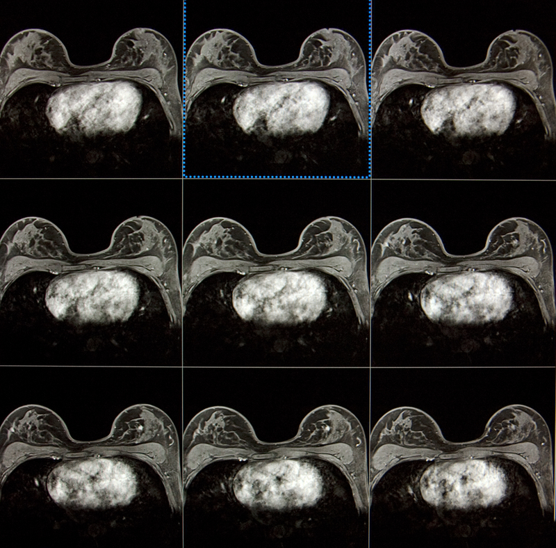 Femeile diagnosticate cu cancer mamar și operate pot evita chimioterapia ulterioară (și efectele secundare ale acesteia) în baza unui test genetic. Acesta restrânge semnificativ numărul persoanelor care chiar au nevoie de acest tratament, fără să crească riscul de recidivă, arată un studiu realizat de UCL din Marea Britanie.